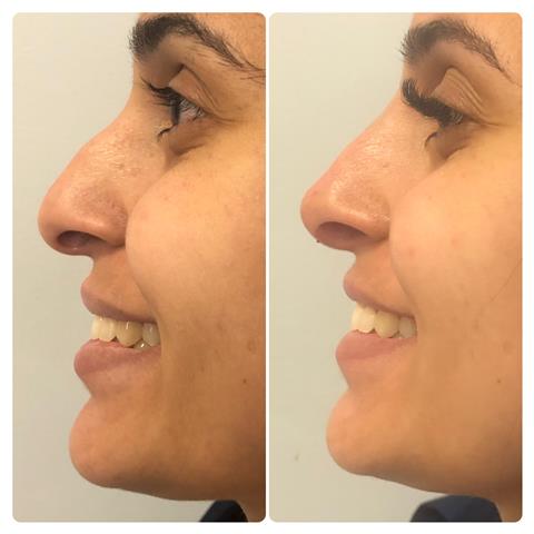 PREENCHIMENTO LABIAL EM JATAÍ - GO