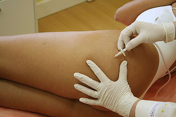 TRATAMENTO DE ESTRIAS E CELULITES EM MACAE - ESPACO CASA AZUL RJ