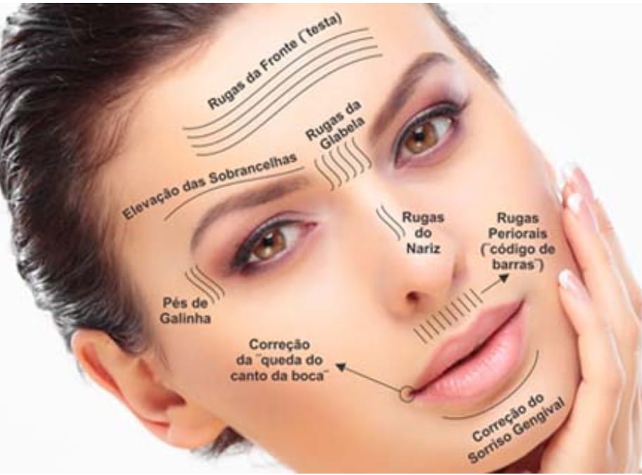 APLICAÇÃO DE BOTOX NO QUIRIRIM - SP