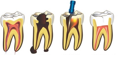 TRATAMENTO DE CANAL EM PETROPOLIS - DR FERNANDO - RJ