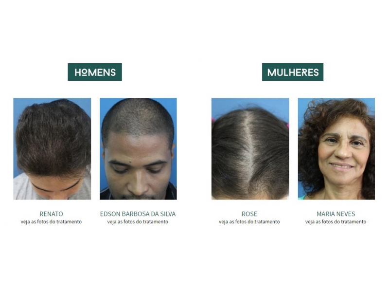 PRODUTOS PARA CALVICE EM TERESÓPOLIS - WhatsApp Online