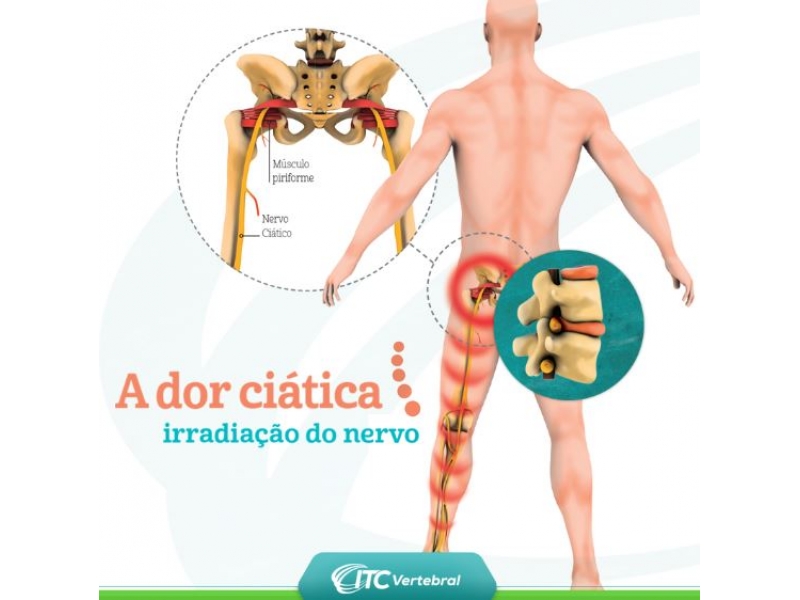 Ciatalgia e Tratamento em Porto Velho - Osteo&Fit