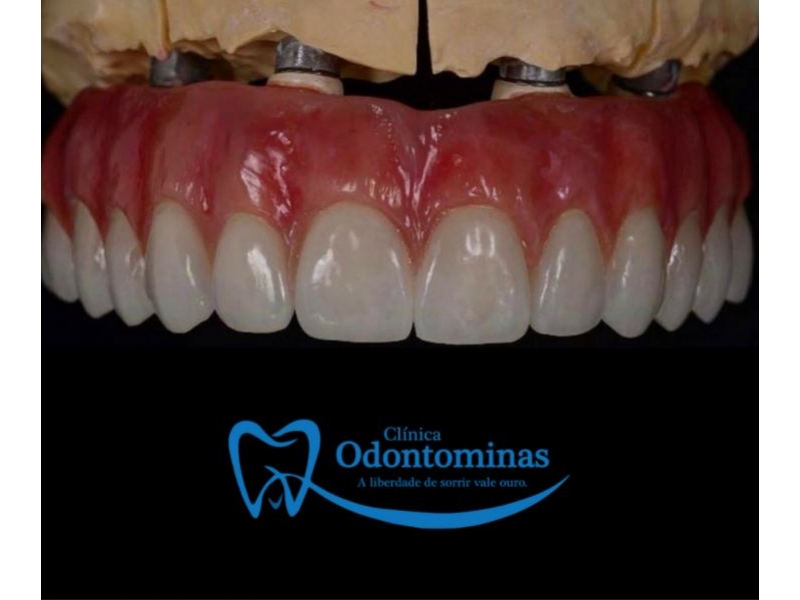 PRÓTESE PROTOCOLO EM MANAUS - AM