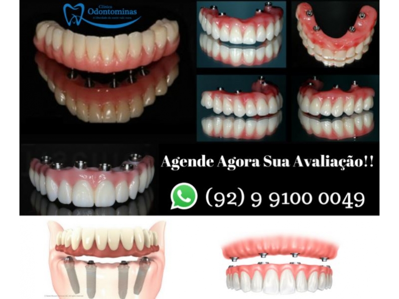 PRÓTESE PROTOCOLO EM MANAUS - AM