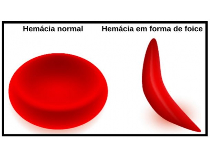 Tratamento Natural para Anemia Falciforme em Rio Branco - NATURAL FITOFARMA