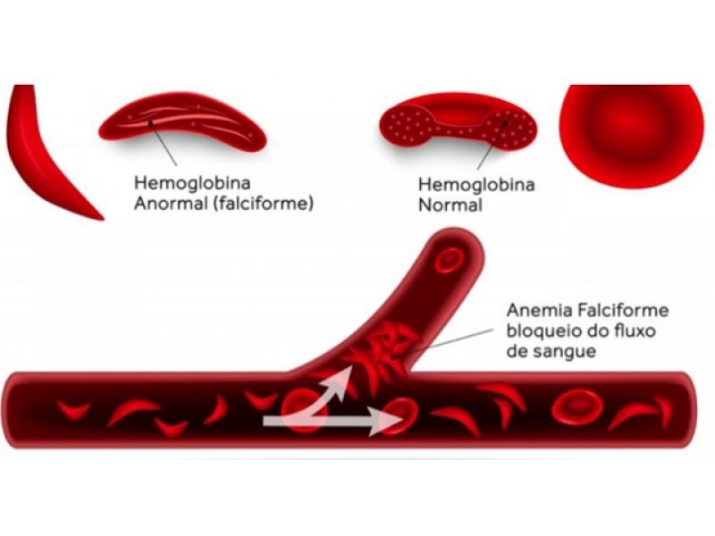 Tratamento Natural para Anemia Falciforme em Rio Branco - NATURAL FITOFARMA