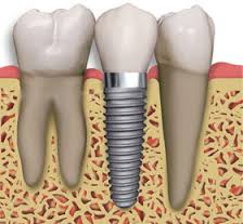 IMPLANTE DENTARIO EM TRES RIOS - O.R.A ODONTOLOGIA