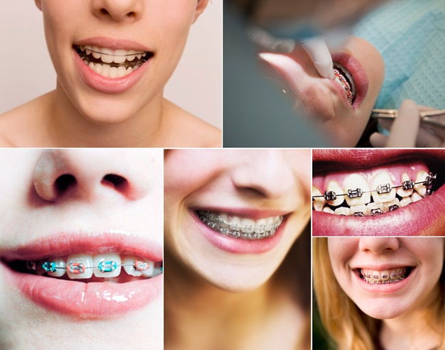 APARELHO ORTODONTICO EM PETROPOLIS