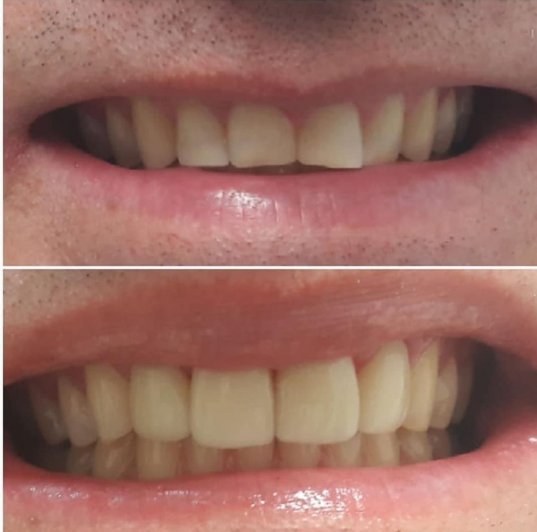 INVISALIGN EM CONTAGEM - MG