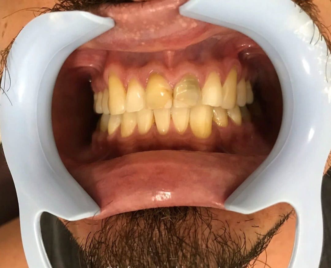 INVISALIGN EM CONTAGEM - MG