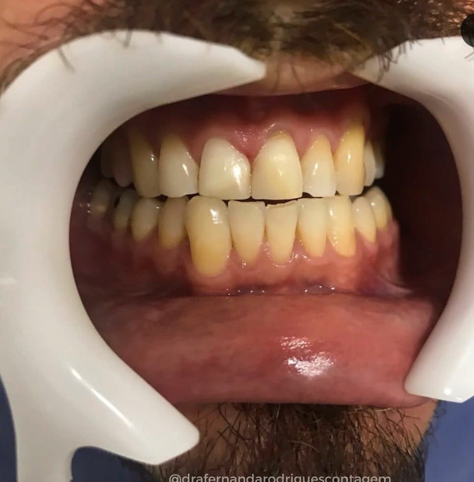 INVISALIGN EM CONTAGEM - MG