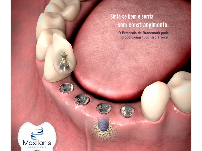 IMPLANTE DENTÁRIO EM ARACATUBA SP