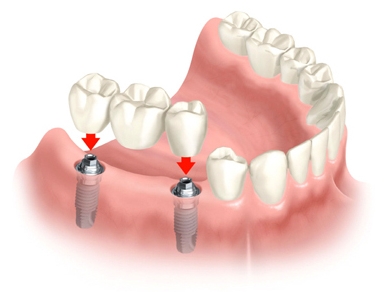 IMPLANTE DENTARIO EM CAMPINAS - IMPLANTES ORAIS - SP