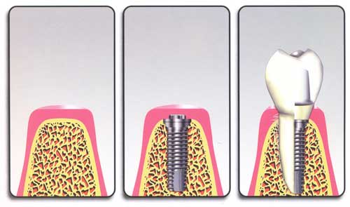 IMPLANTE DENTARIO EM CAMPINAS - IMPLANTES ORAIS - SP