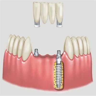 IMPLANTE DENTARIO EM SAO GONCALO RJ - SORRISO AMPLO