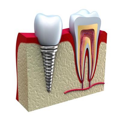 IMPLANTE DENTARIO EM SAO GONCALO RJ - SORRISO AMPLO