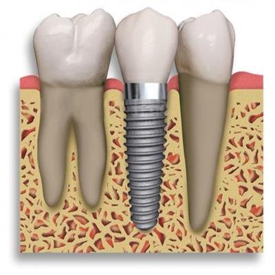 IMPLANTE DENTARIO EM SAO GONCALO RJ - SORRISO AMPLO