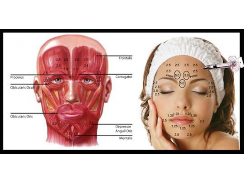 APLICAÇÃO DE BOTOX FACIAL NO RECREIO - BIOPLASTIA OROFACIAL - RJ