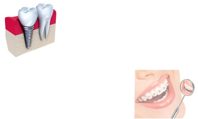 IMPLANTES EM PETROPOLIS