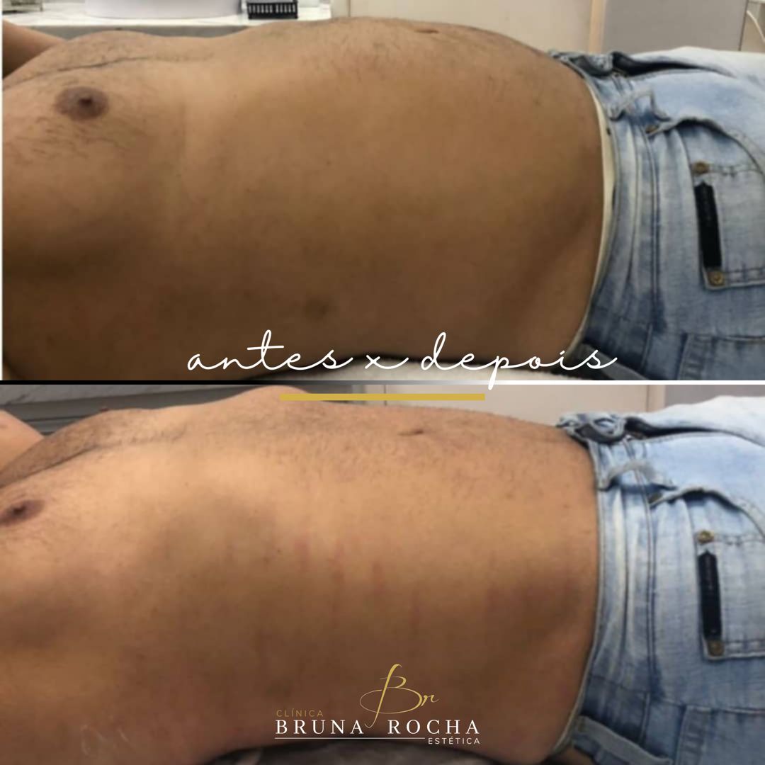 TRATAMENTO PARA LEVANTAR BUMBUM EM PETRÓPOLIS 