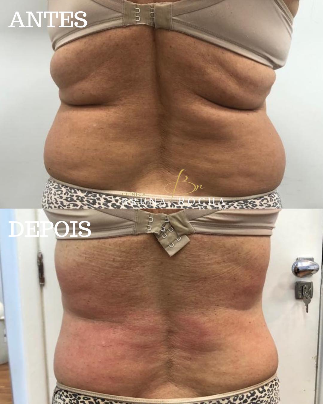 TRATAMENTO PARA LEVANTAR BUMBUM EM PETRÓPOLIS 