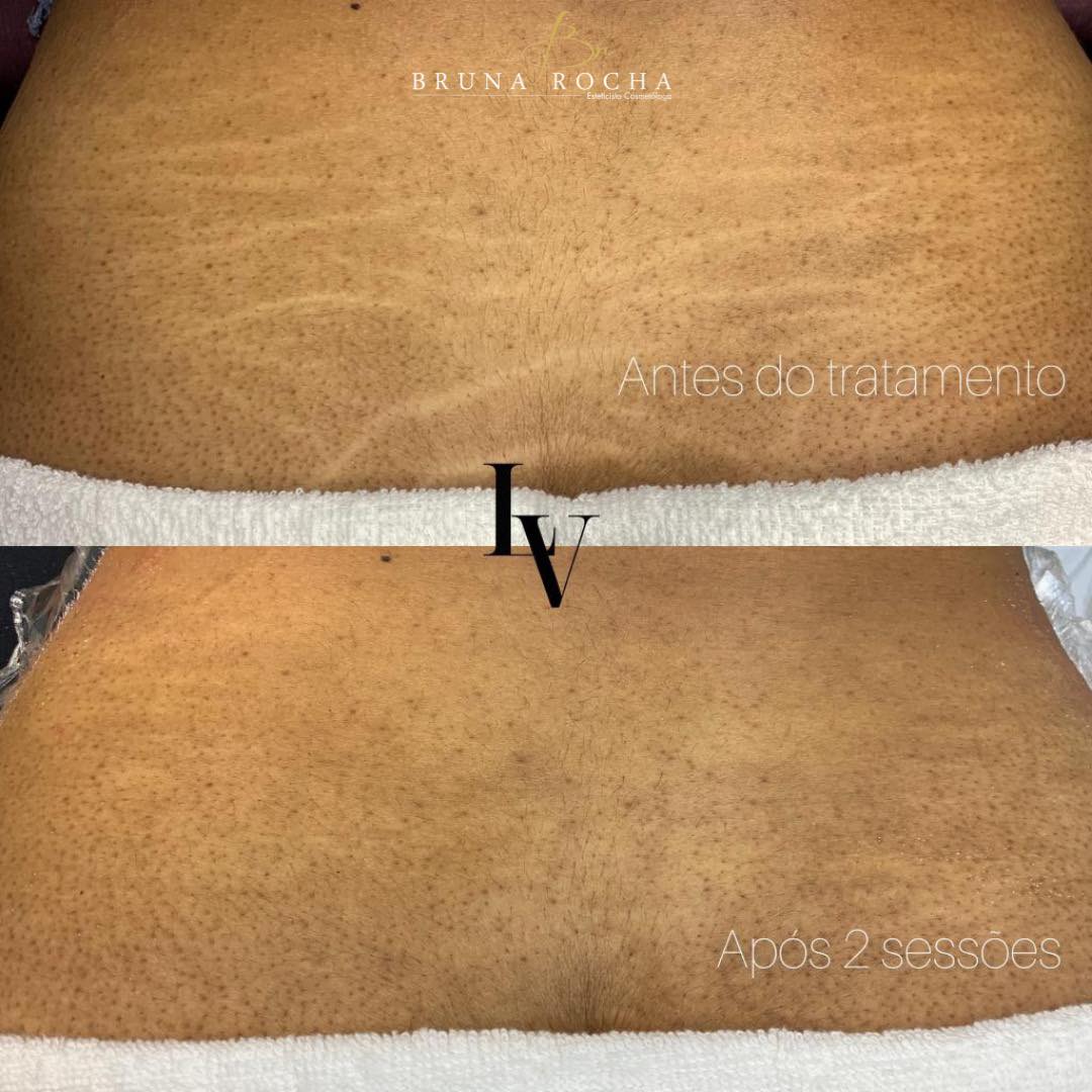 TRATAMENTO PARA LEVANTAR BUMBUM EM PETRÓPOLIS 