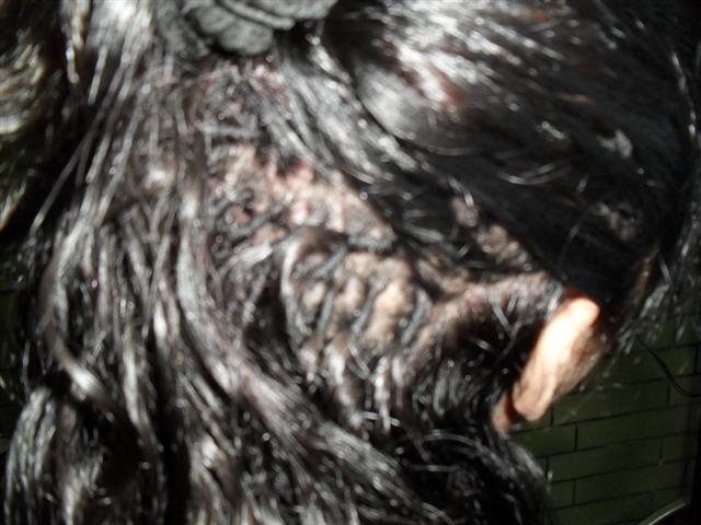 IMPLANTE CAPILAR EM PIABETA - LÉA TRANSFORMAÇÃO - RJ