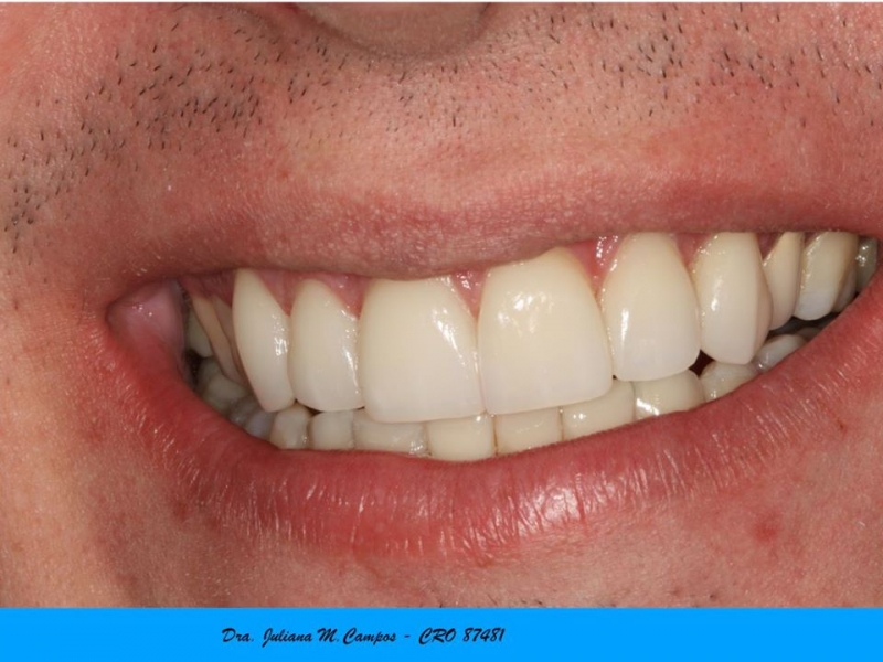 IMPLANTE DENTÁRIO EM SÃO JOSÉ DO RIO PRETO - SP