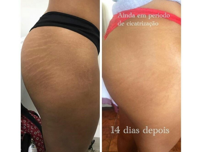 CAMUFLAGEM DE ESTRIAS EM BELO HORIZONTE