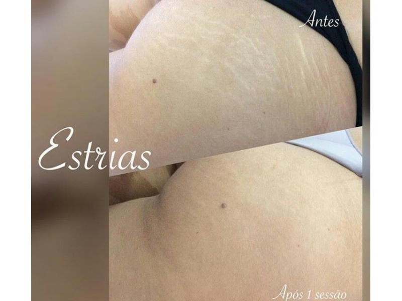 CAMUFLAGEM DE ESTRIAS EM BELO HORIZONTE