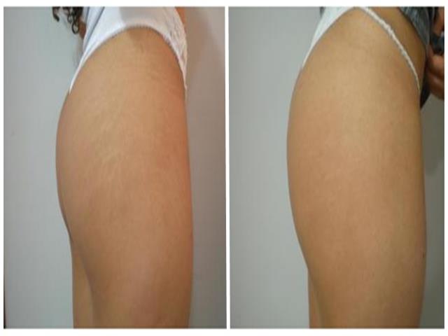 TRATAMENTO DE ESTRIAS E CELULITES EM RIBEIRAO PRETO - FISIO BEAUTY - SP