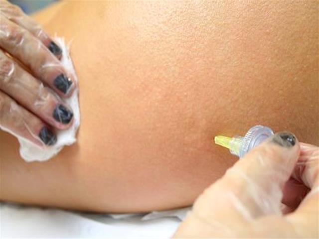 TRATAMENTO DE ESTRIAS E CELULITES EM RIBEIRAO PRETO - FISIO BEAUTY - SP